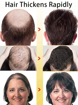 Saç Büyüme Yağı Hızlı Saç Büyüme Etkili Kellik Onarım Kalıtsal Saç Dökülmesi Doğum Sonrası Saç Dökülmesi Seboreik Saç Dökülmesi